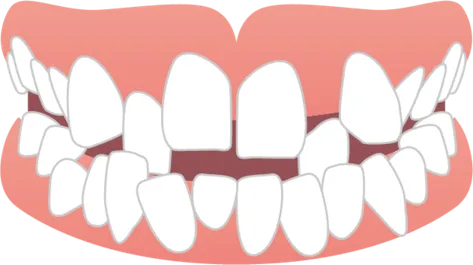 歯並びが悪いイラスト