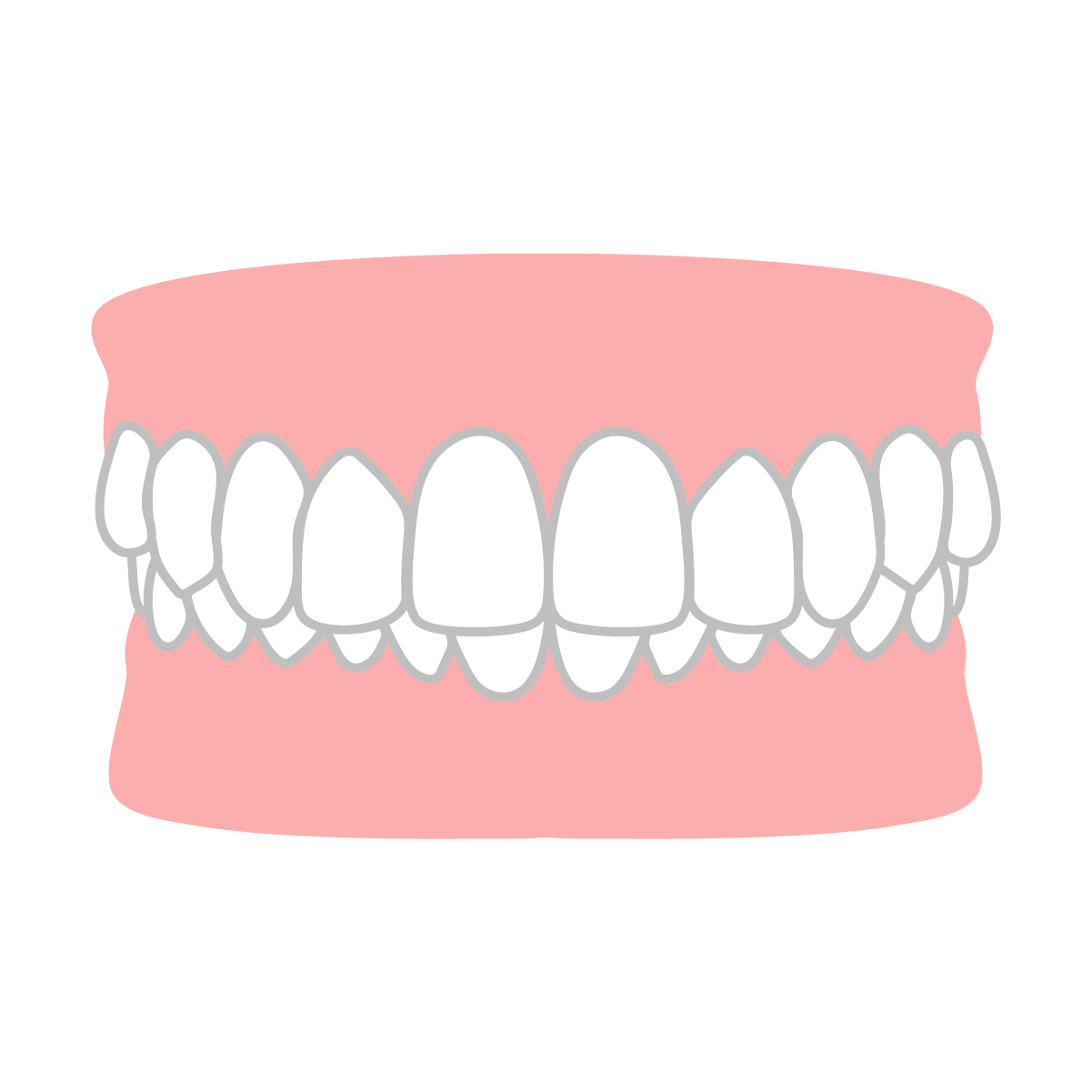 噛み合わせが深い（過蓋咬合）が気になる