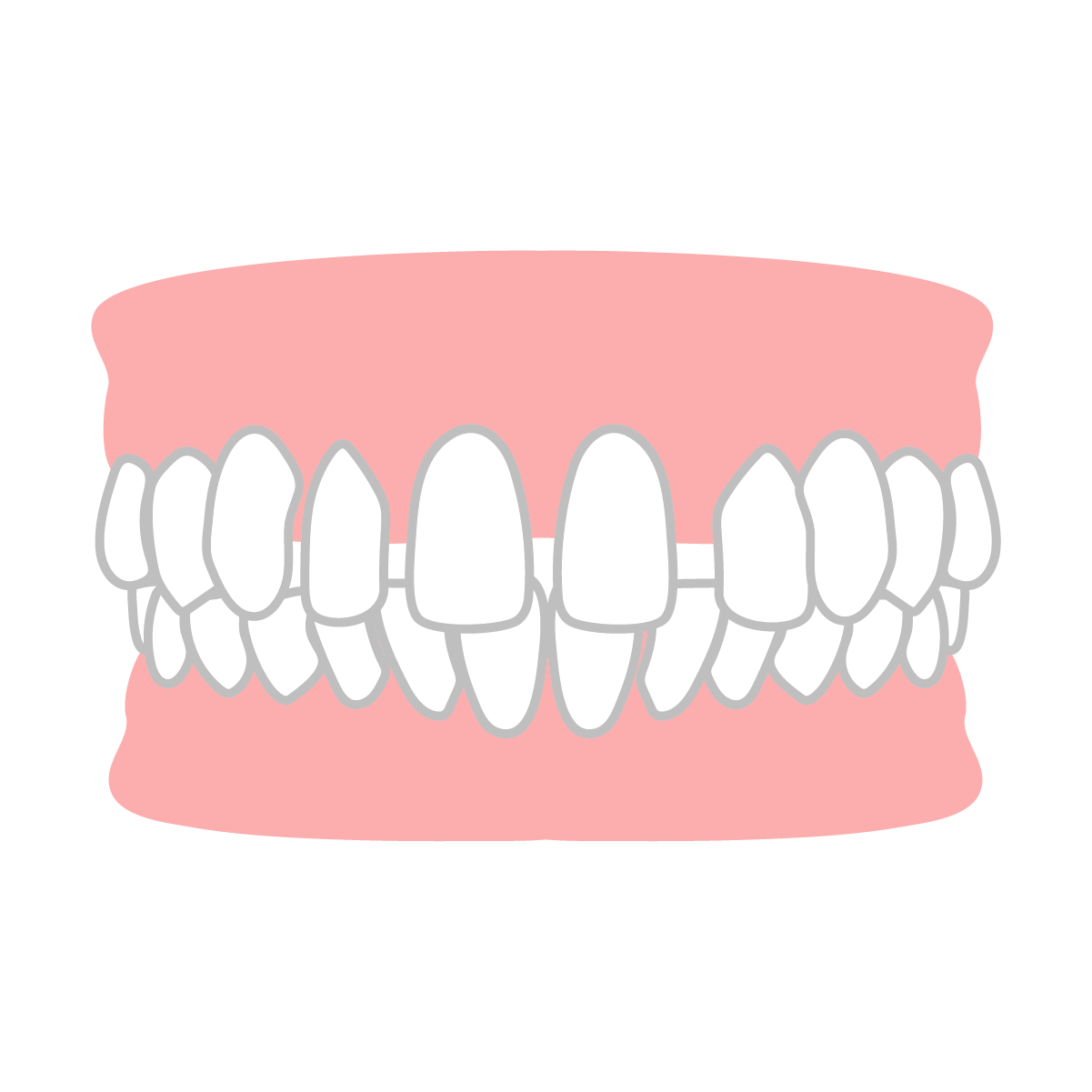 すきっ歯（空隙歯列）を治したい