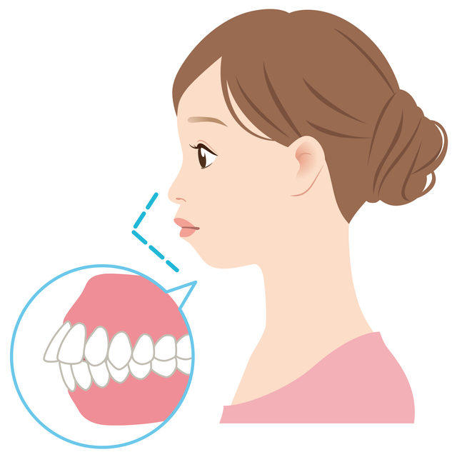 出っ歯　治療方法　歯科矯正