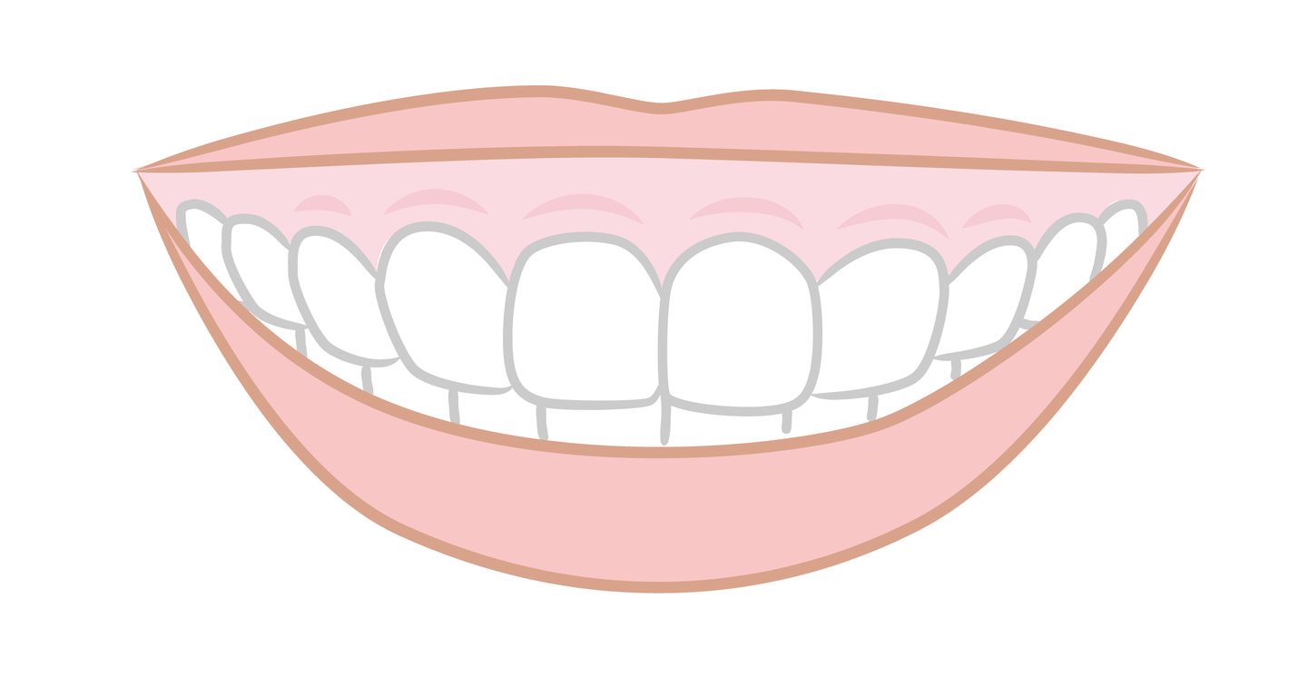 ガミースマイル　歯茎が見える　矯正治療