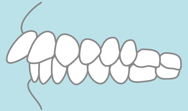 出っ歯　上顎前突　歯並び