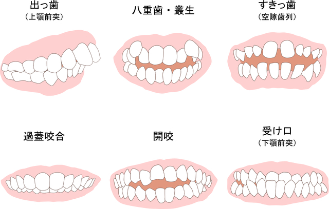 歯の症例　矯正するべき歯並び　歯列矯正