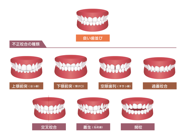 歯並び　矯正歯科　歯列矯正