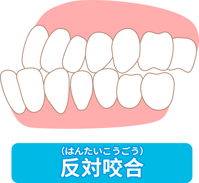 受け口　低位舌　改善