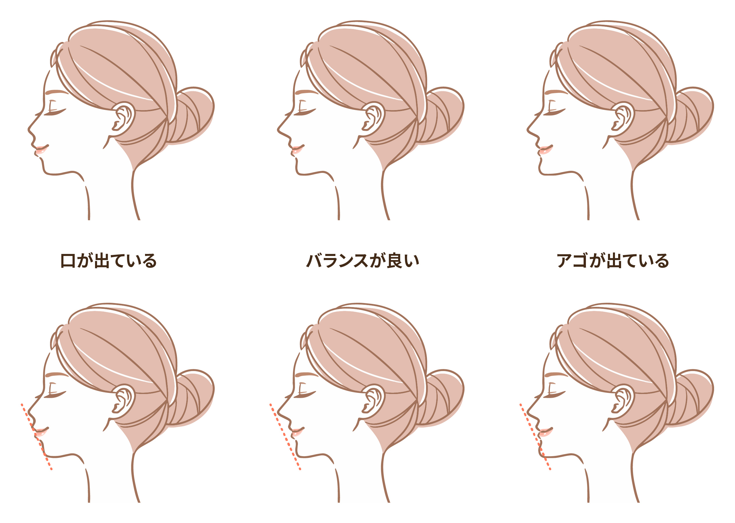 横顔　Eライン　矯正後変化