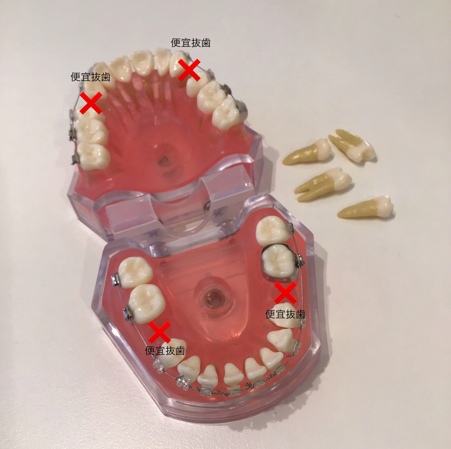 矯正前治療　便宜抜歯　矯正抜歯