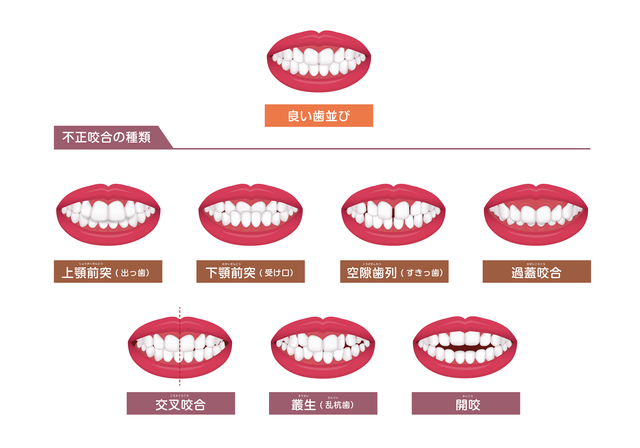 矯正するべき歯　症例　歯列矯正