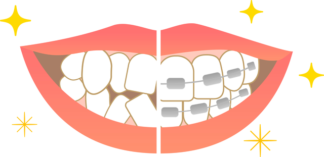 綺麗な歯　ガタガタな歯　歯列矯正