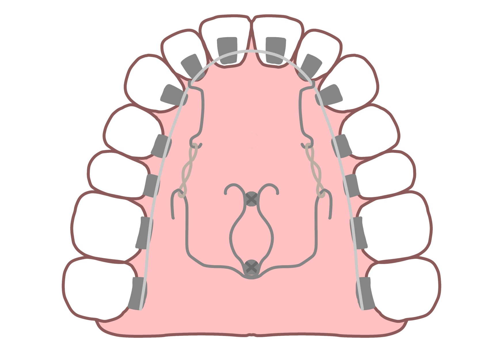 アンカースクリュー　歯列矯正治療　口蓋正中