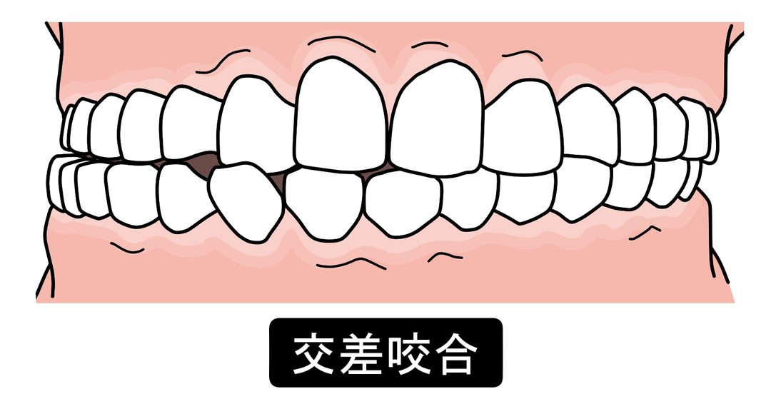 クロスバイト　交差咬合　歯列矯正