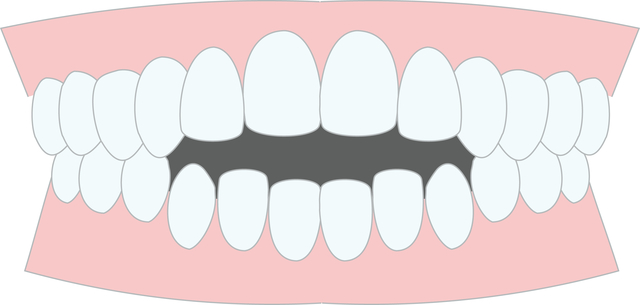 開口　歯の症例　歯列矯正