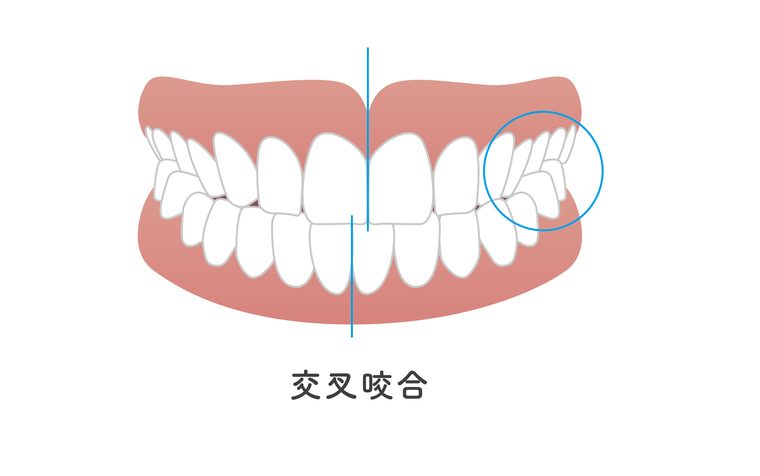 交叉咬合　歯列矯正　歯並び