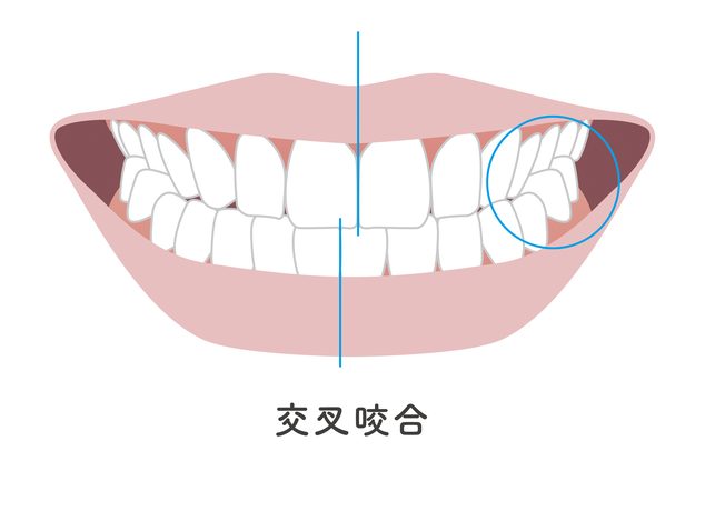 交叉咬合　歯並び　歯科矯正