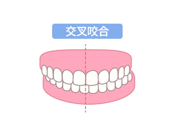 交叉咬合　歯科矯正　歯並び