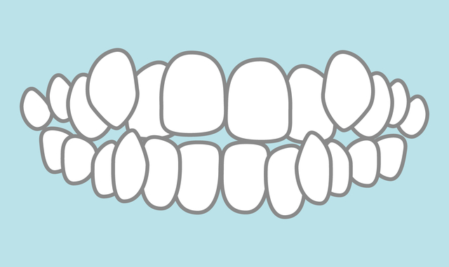 八重歯　歯並び　歯科矯正
