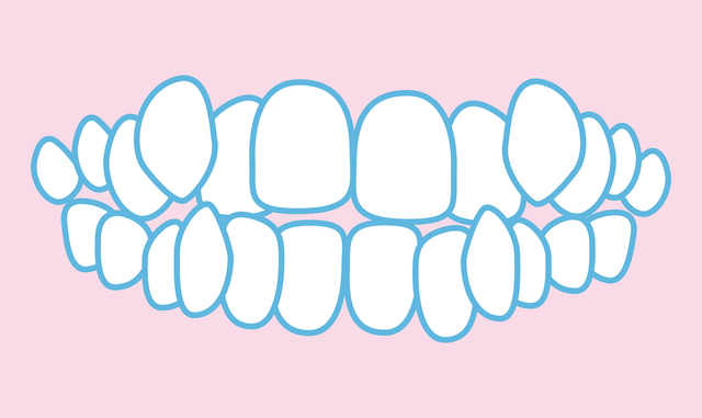 八重歯　歯並び　悪い