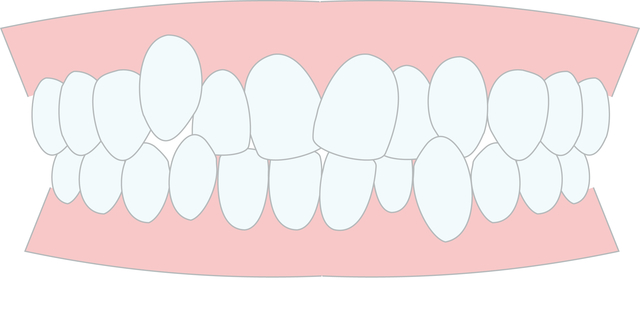 八重歯　原因　歯列矯正