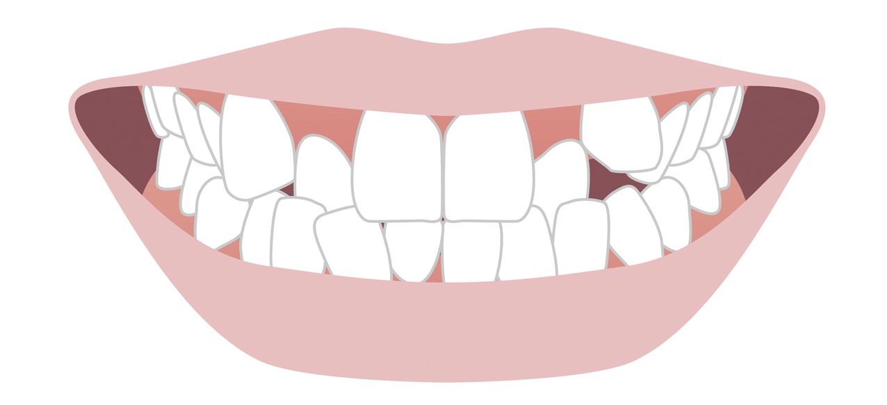 八重歯　かみ合わせ　治療
