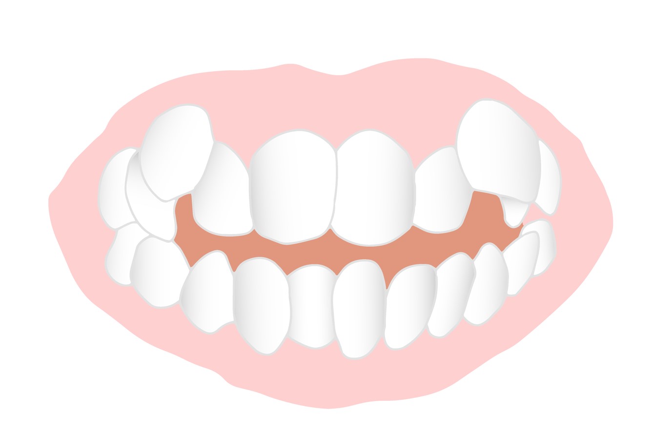 八重歯　叢生　歯科矯正