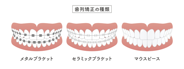 矯正装置　全体矯正　種類