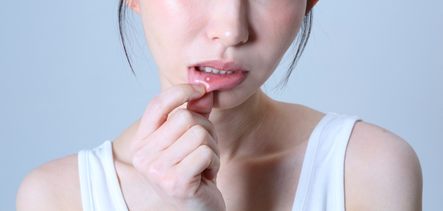 口内炎　種類　対処法