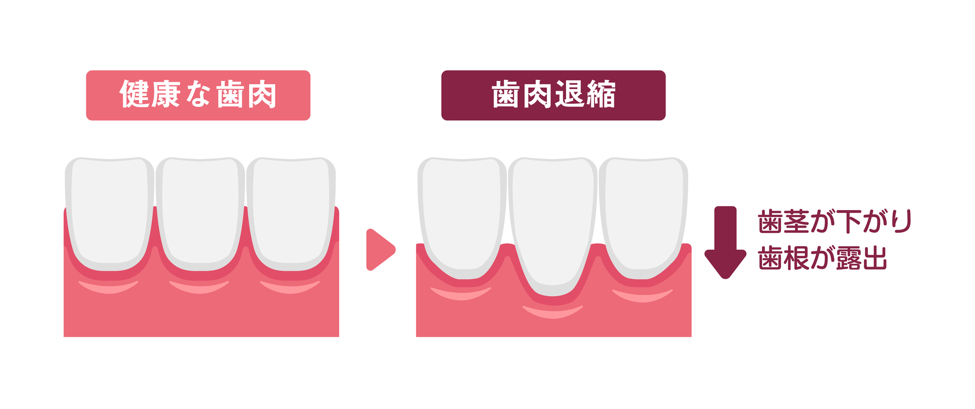 歯肉退縮　歯茎下がる　原因
