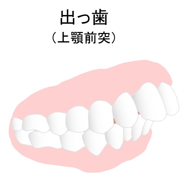 歯列矯正　垢抜け　出っ歯