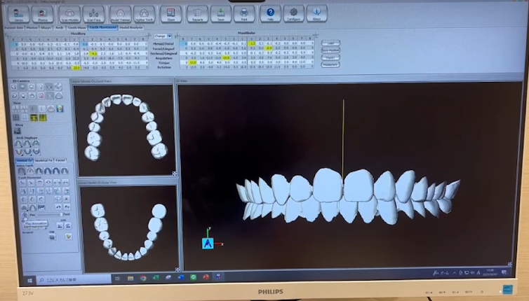 ３Dシミュレーション　歯並び　改善