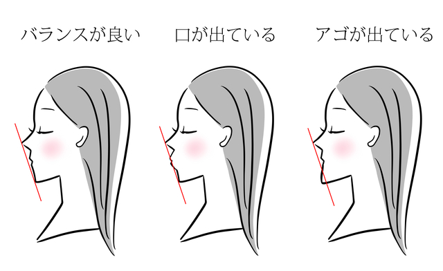 横顔　Eライン　歯列矯正