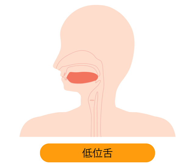 低位舌　舌癖　受け口原因