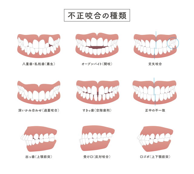 不正咬合　種類　歯列矯正