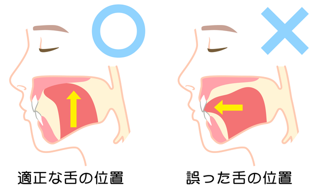 舌の位置　舌の癖　MFT