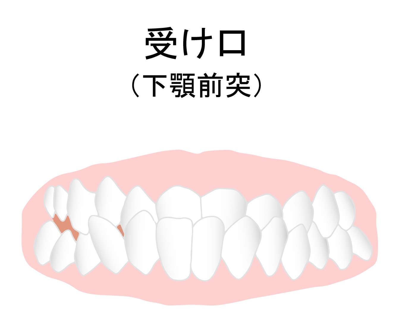 受け口　改善　歯列矯正