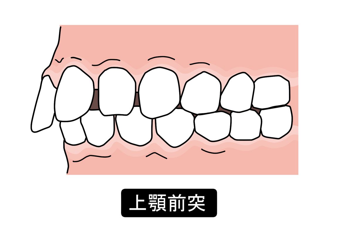 上顎前突　出っ歯　歯列矯正