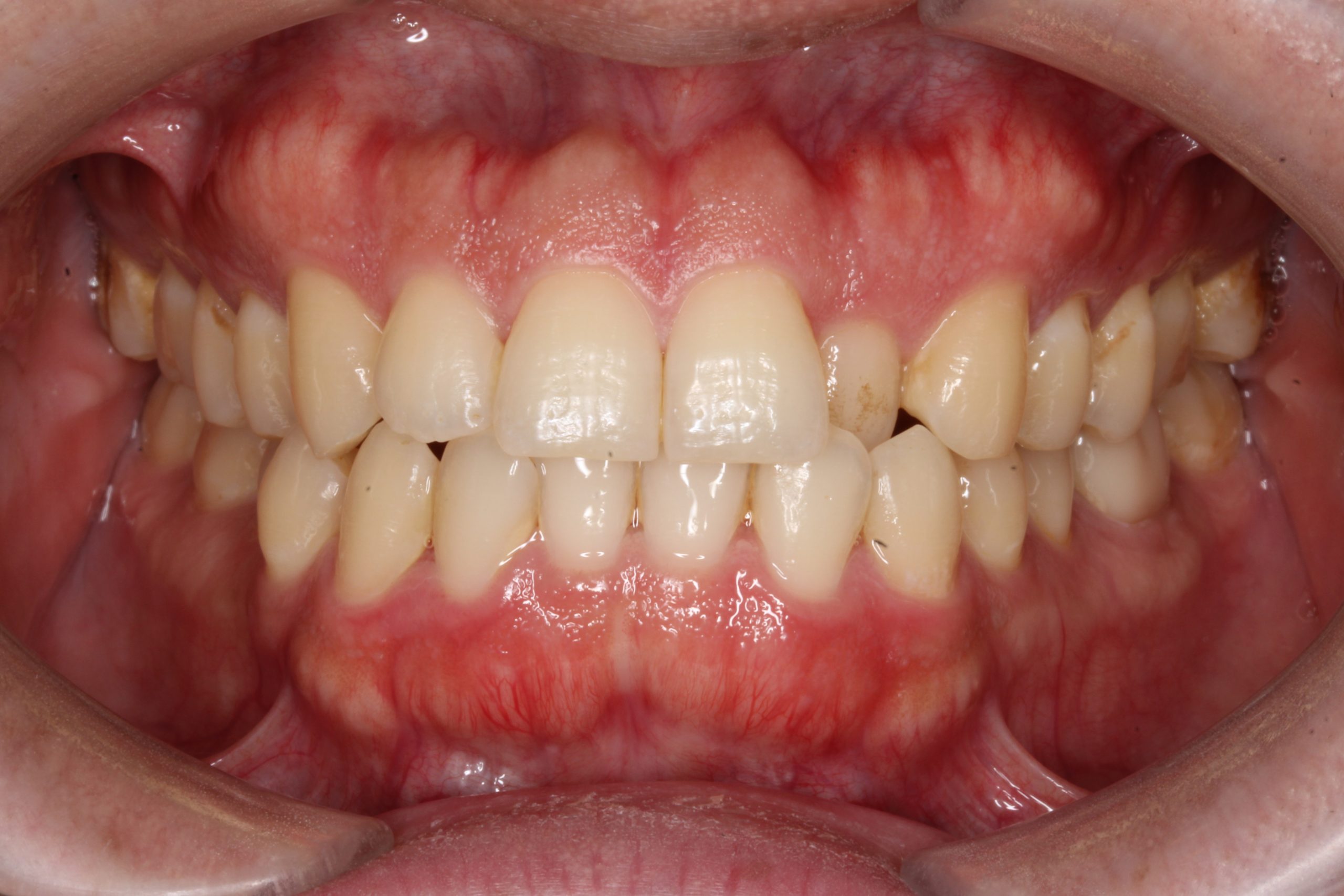 歯の凸凹を治したい₋ラビアルの症例