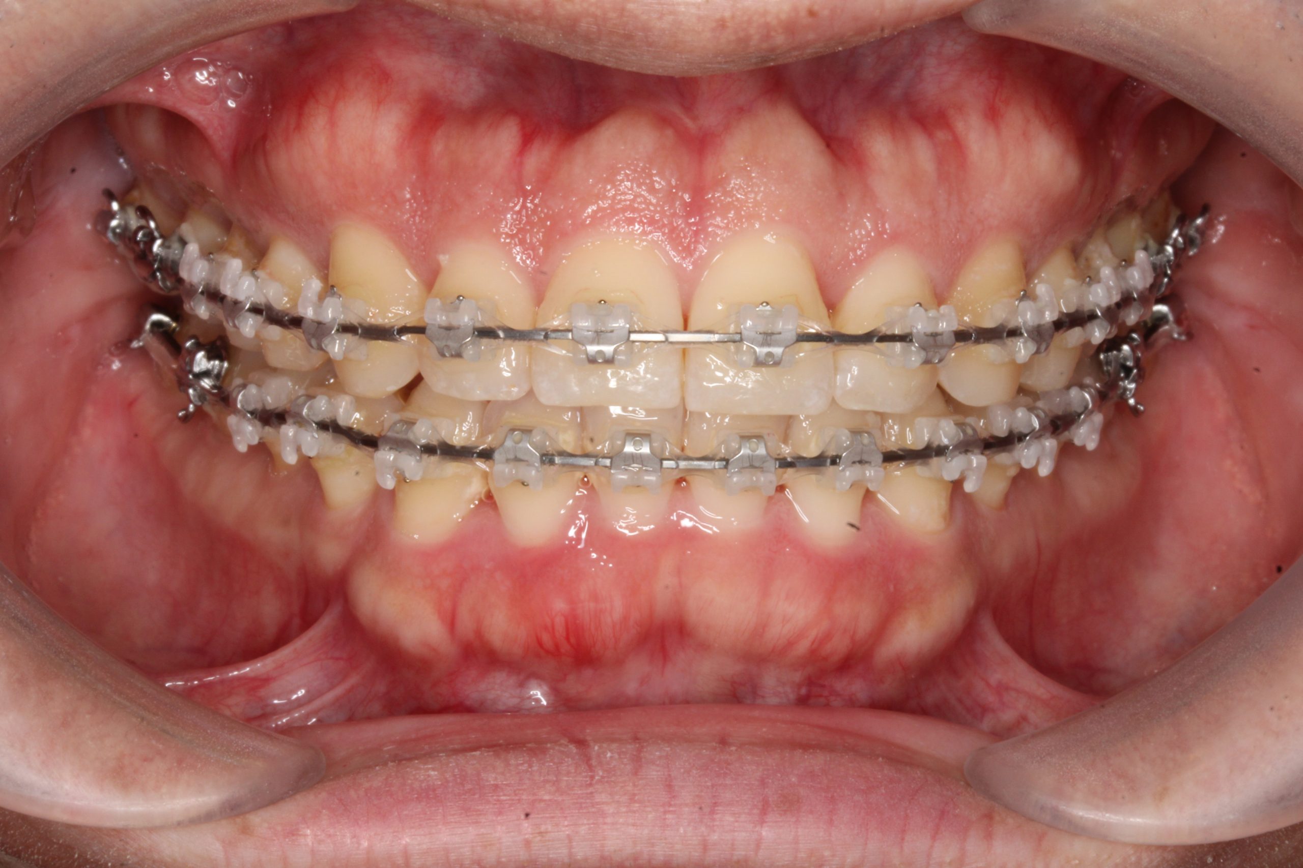歯の凸凹を治したい₋ラビアルの症例
