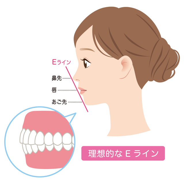 口ゴボ　改善　非抜歯
