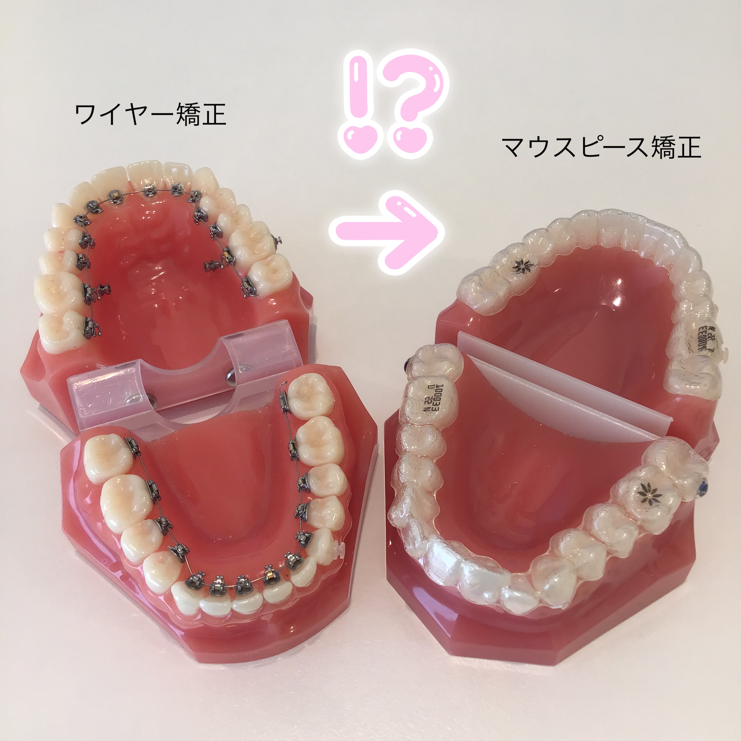 ワイヤー矯正　マウスピース矯正　移行