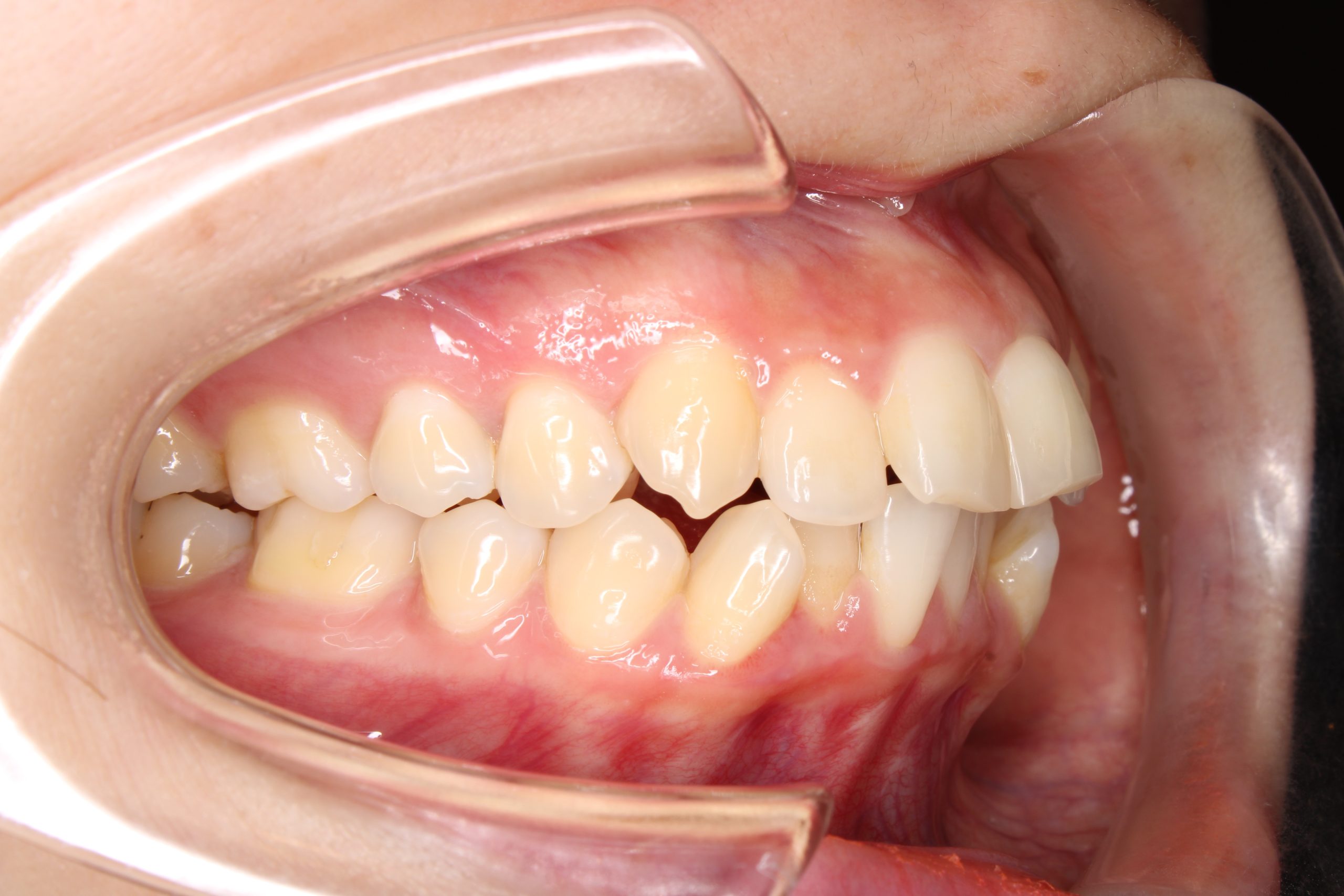 出っ歯を治したい‐リンガルの症例