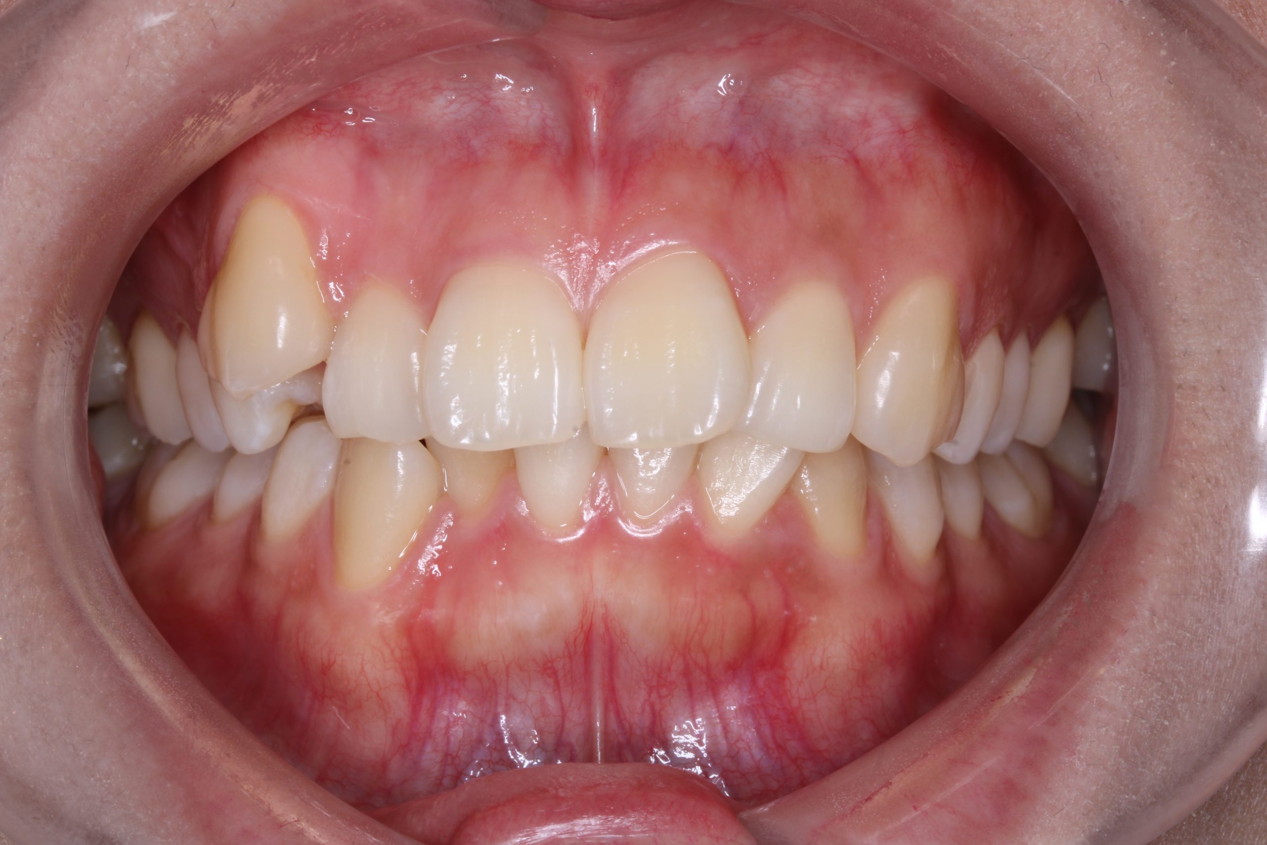 八重歯を治したい‐ハーフリンガルの症例