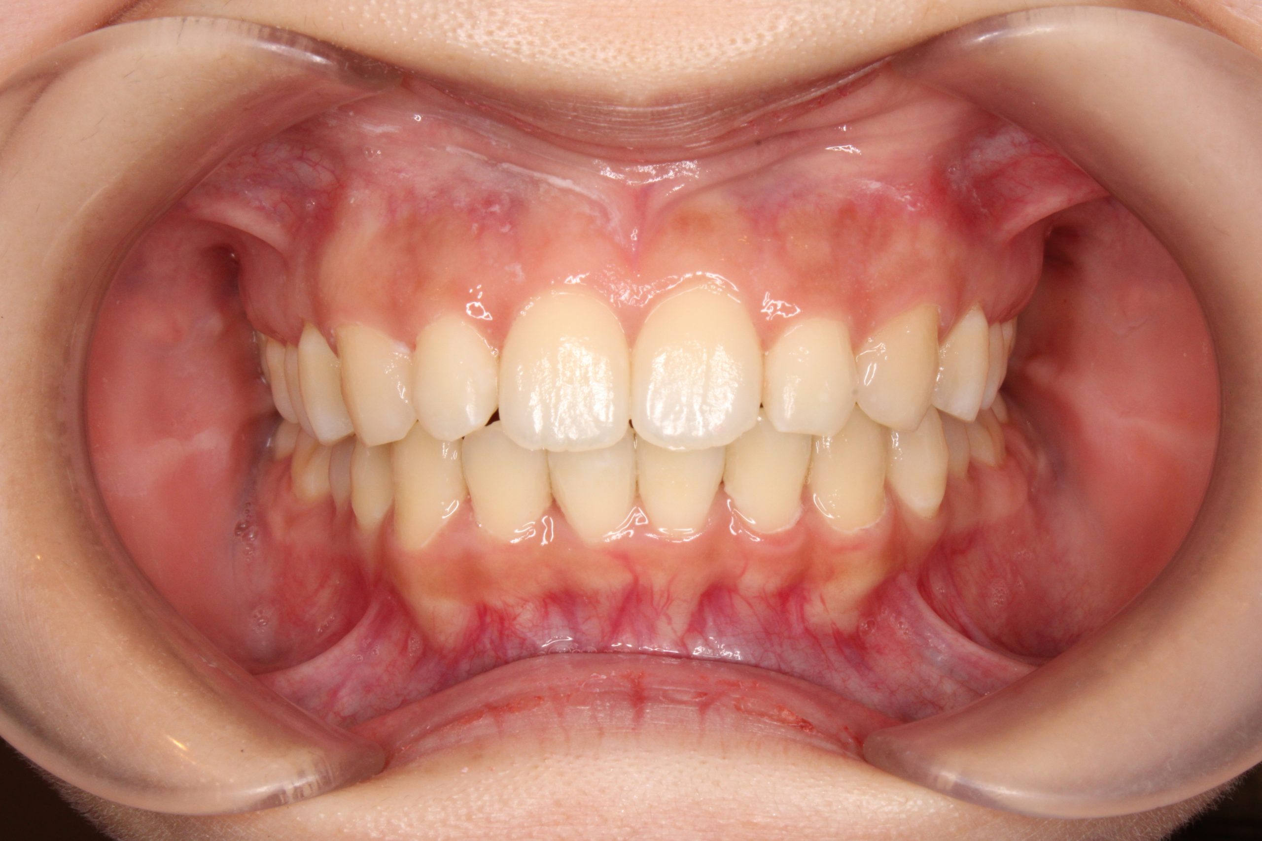 歯の凸凹を治したい‐リンガルの症例