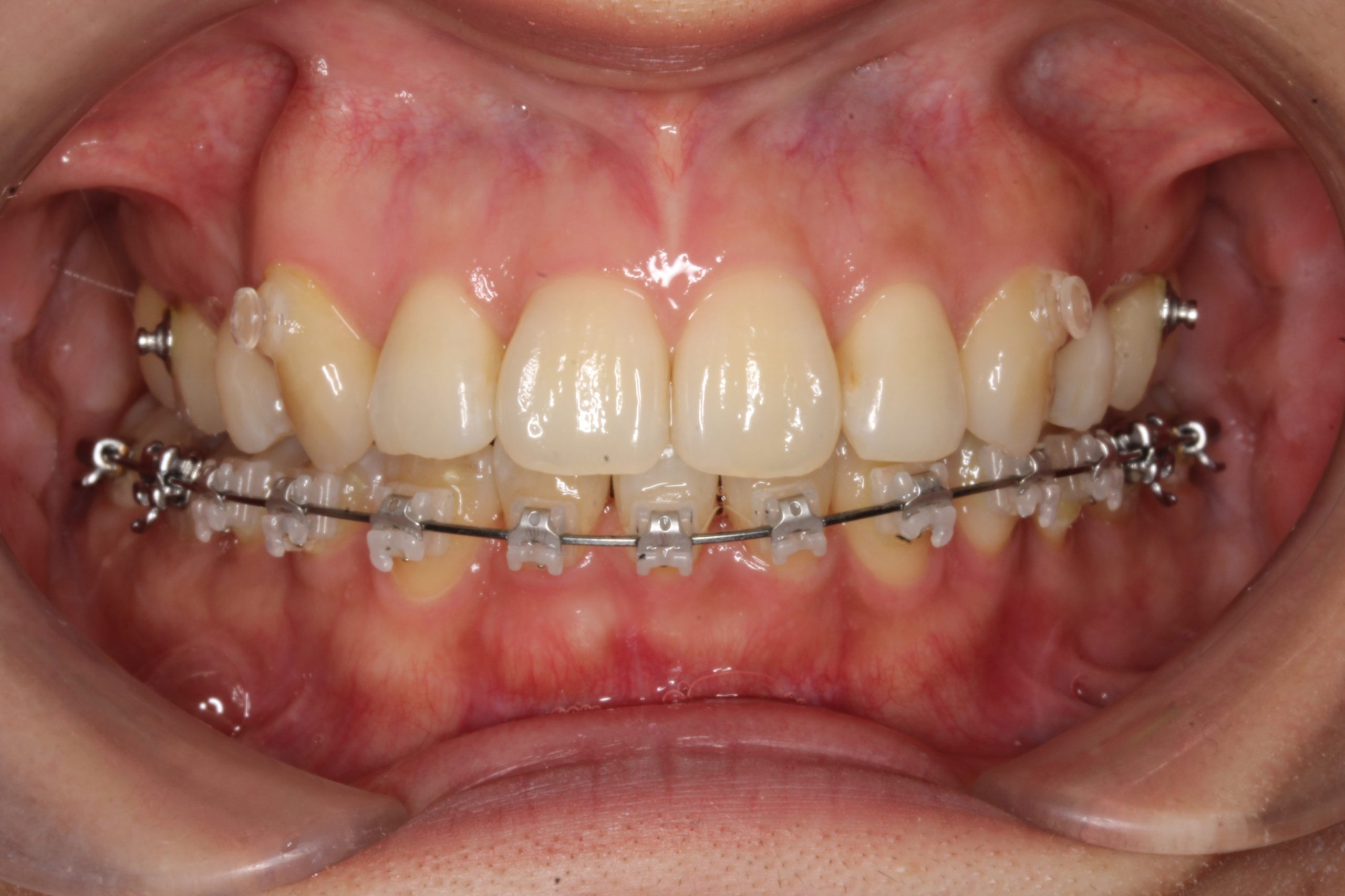 八重歯を治したい‐ハーフリンガルの症例