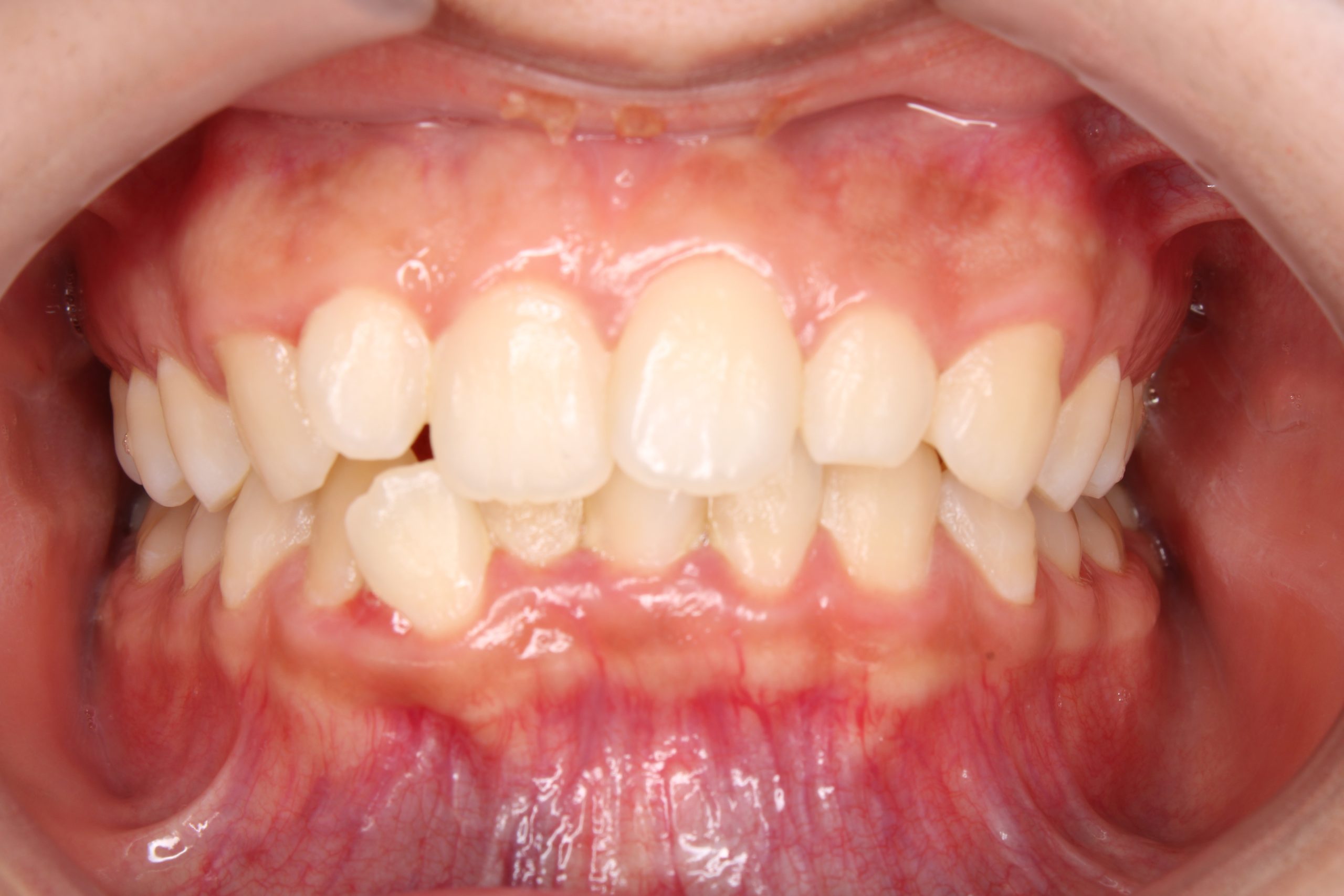 歯の凸凹を治したい‐リンガルの症例