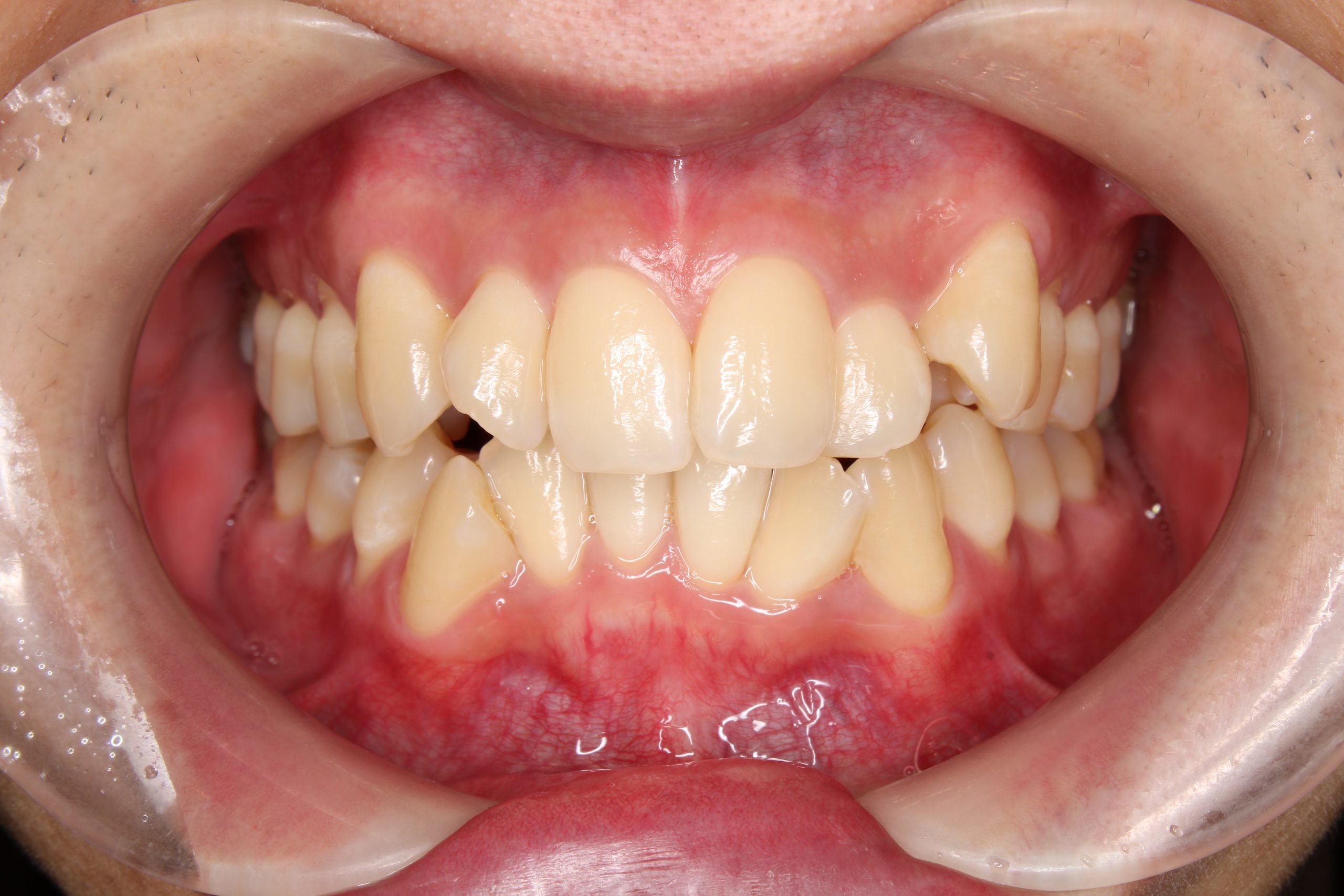 歯の凸凹を治したい‐リンガルの症例