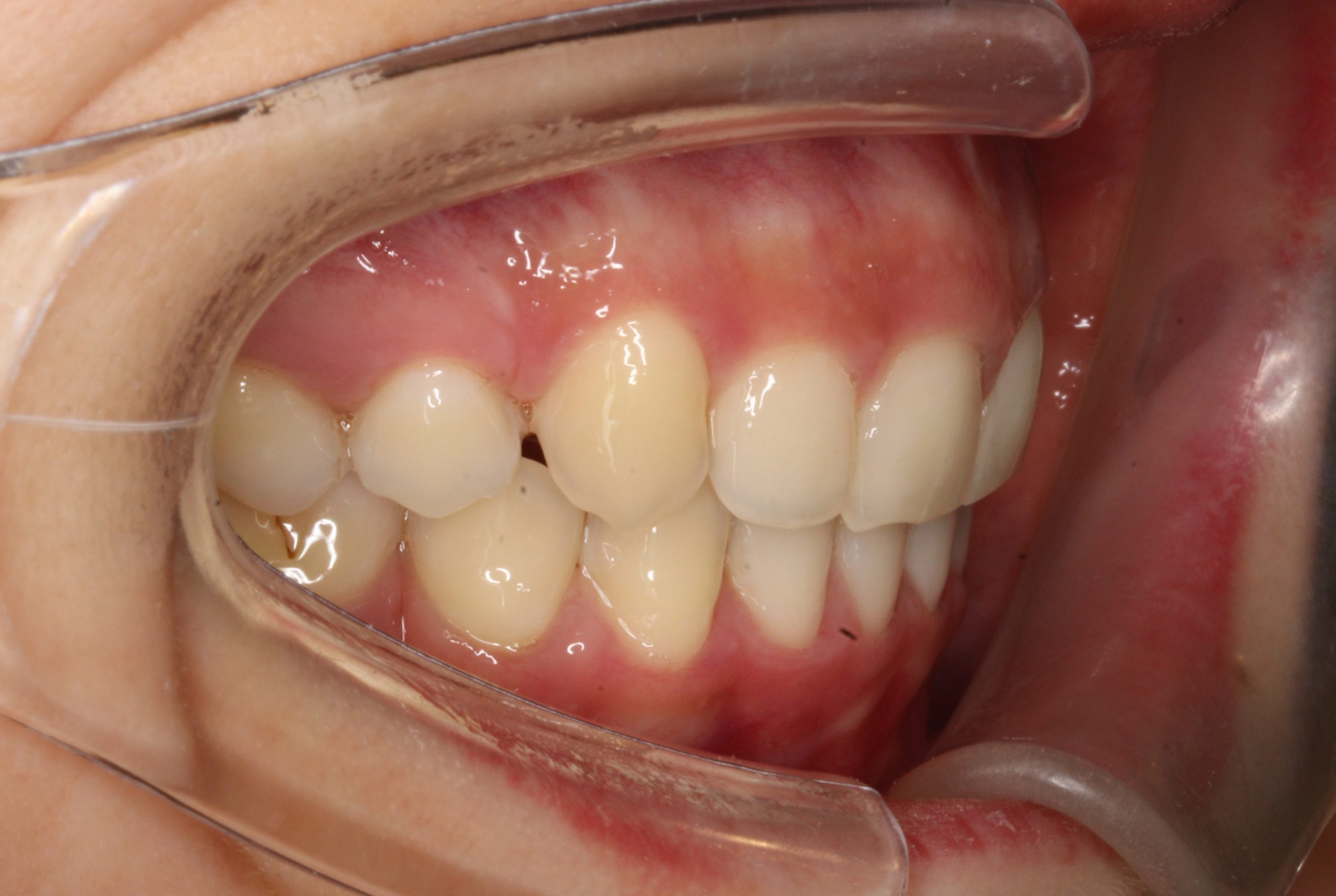出っ歯を治したい‐リンガルの症例