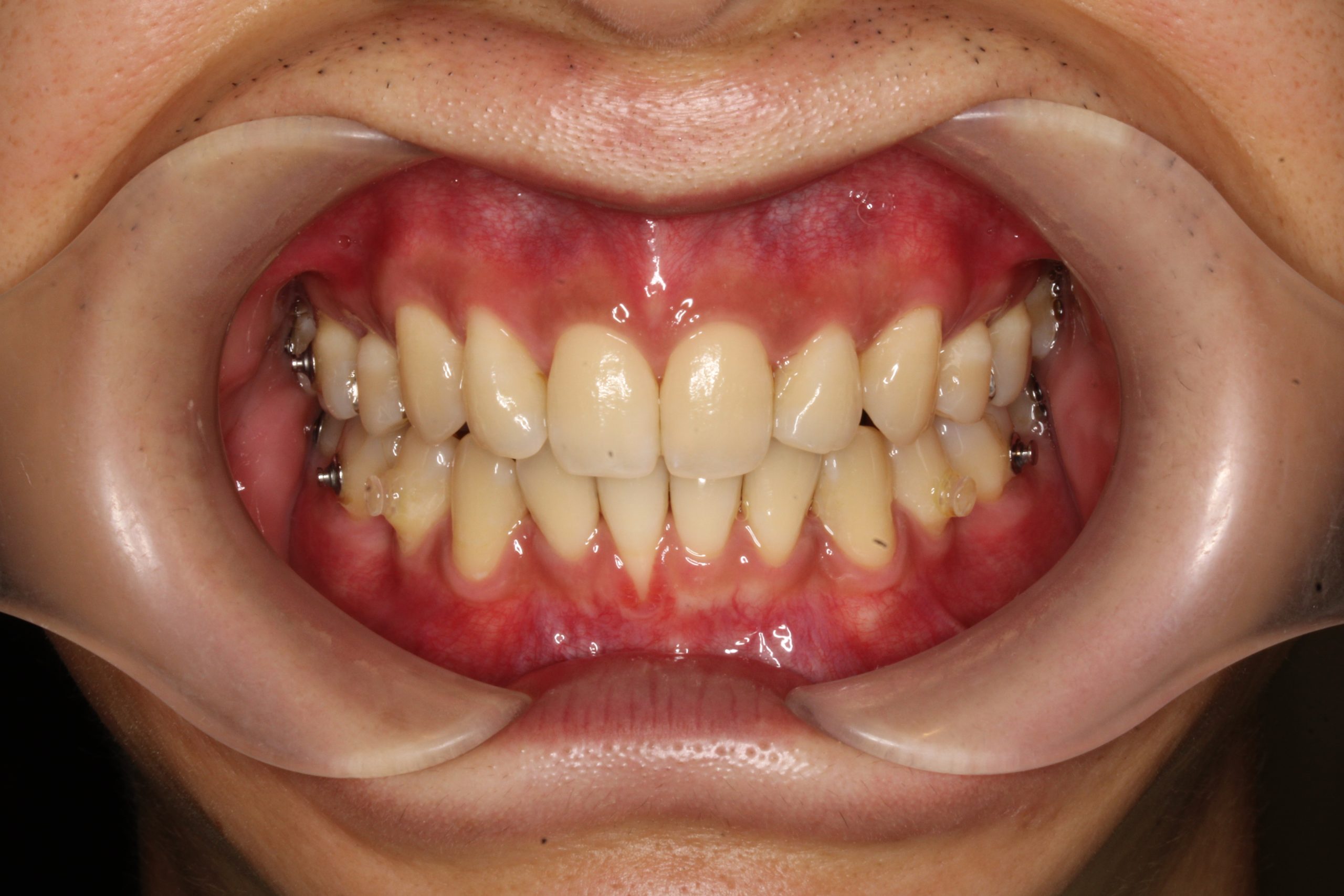 歯の凸凹を治したい‐リンガルの症例