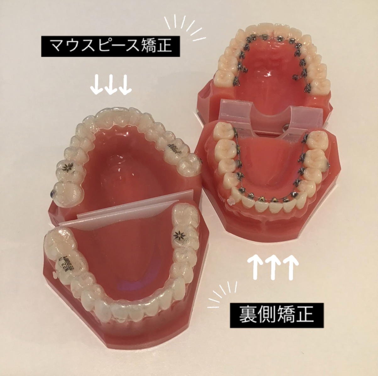 矯正装置　比較　得意な動き
