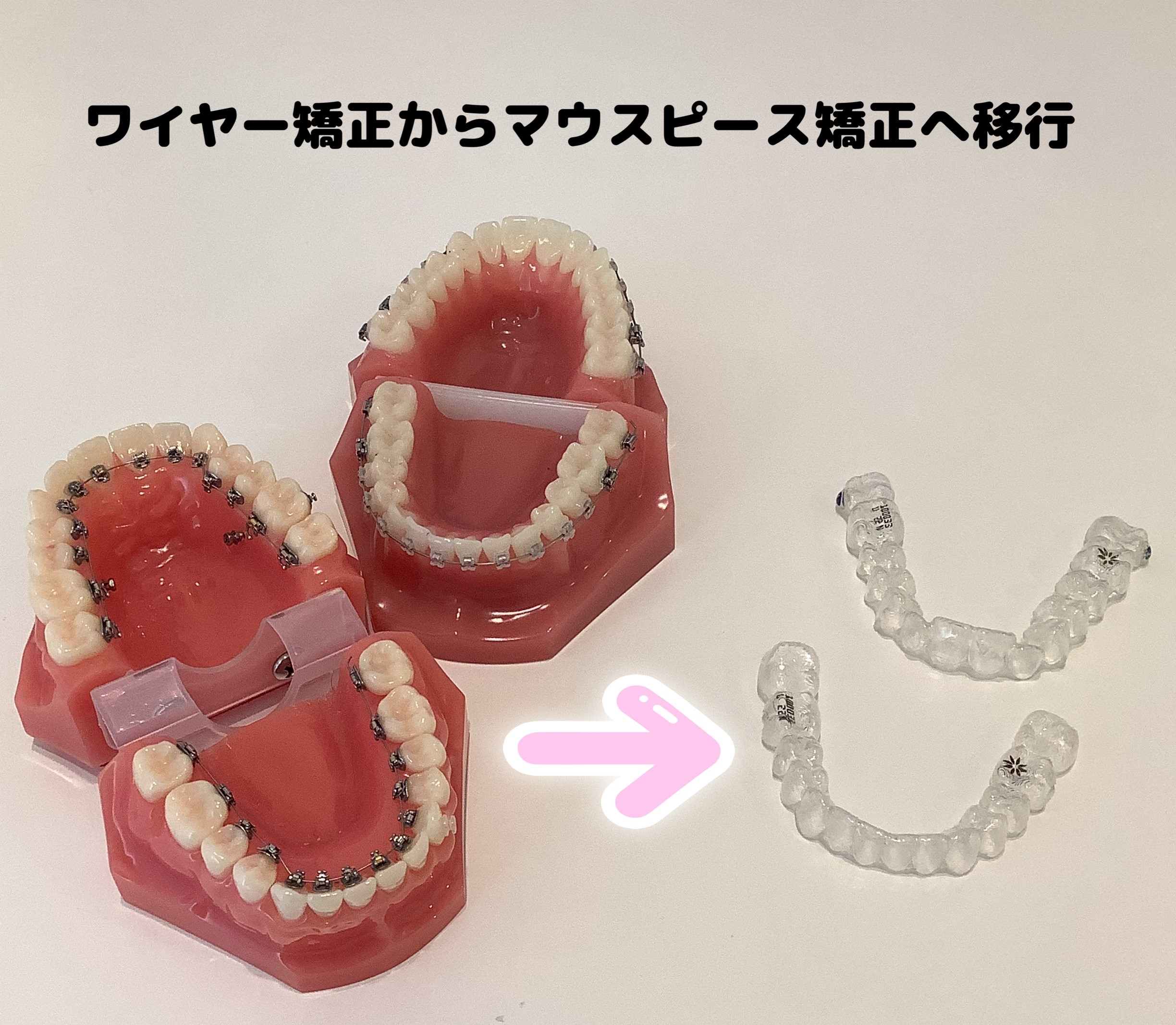 ワイヤー矯正　マウスピース矯正　移行