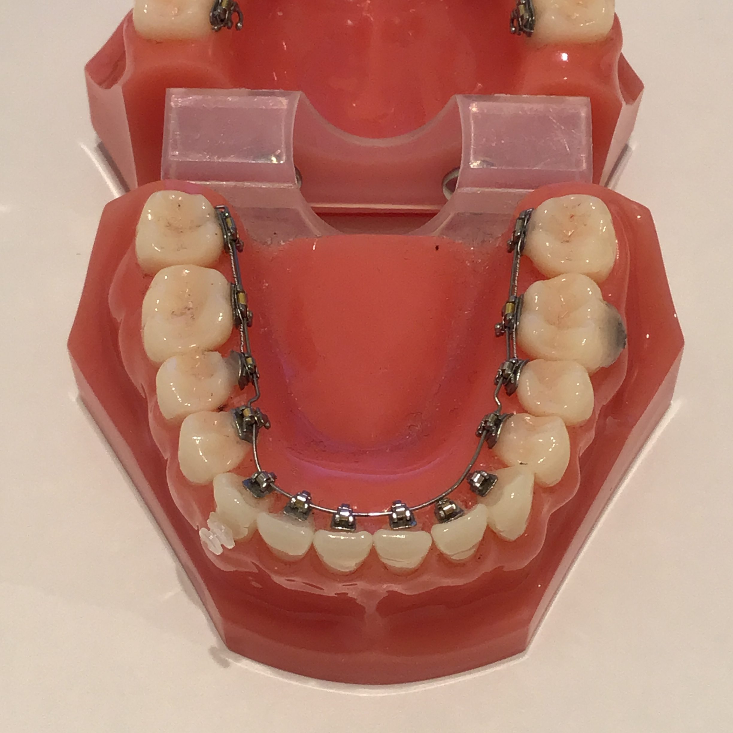 裏側矯正 気になる 質問
